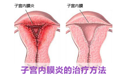 子宫内膜炎该怎么治疗